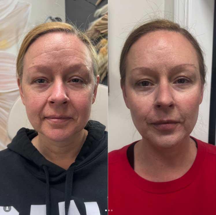 Before and after comparison of a woman's face showing skincare results.